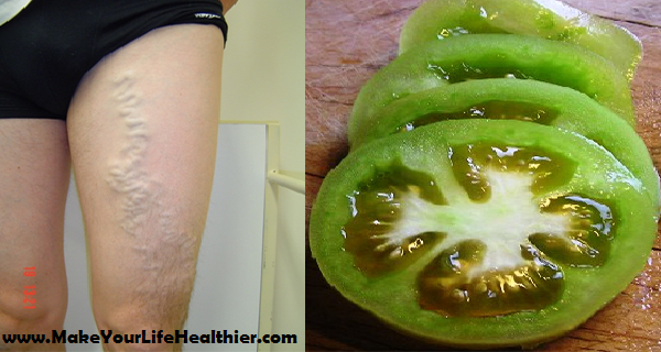 Simple tips to Cure Varicose Veins with the aid of Tomato
