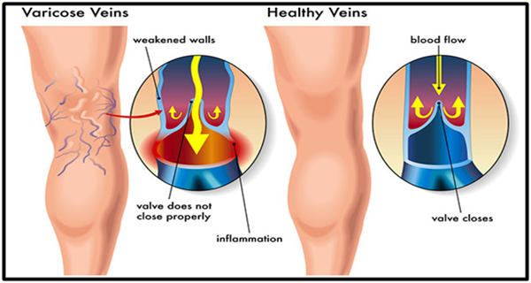 Prepare-This-Garlic-Oil-And-Prevent-Inflammation-The-Main-Cause-of-Varicose-Veins