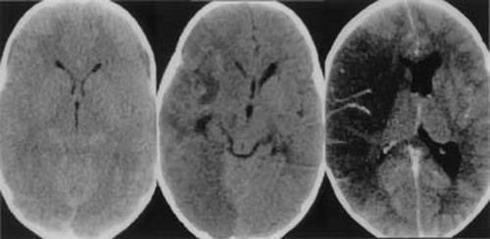 cerebro-comido-por-ameba