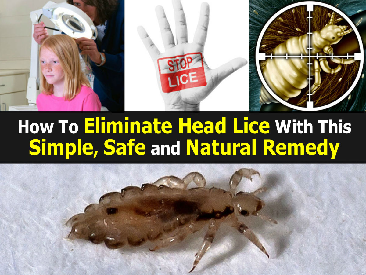 eliminate-head-lice