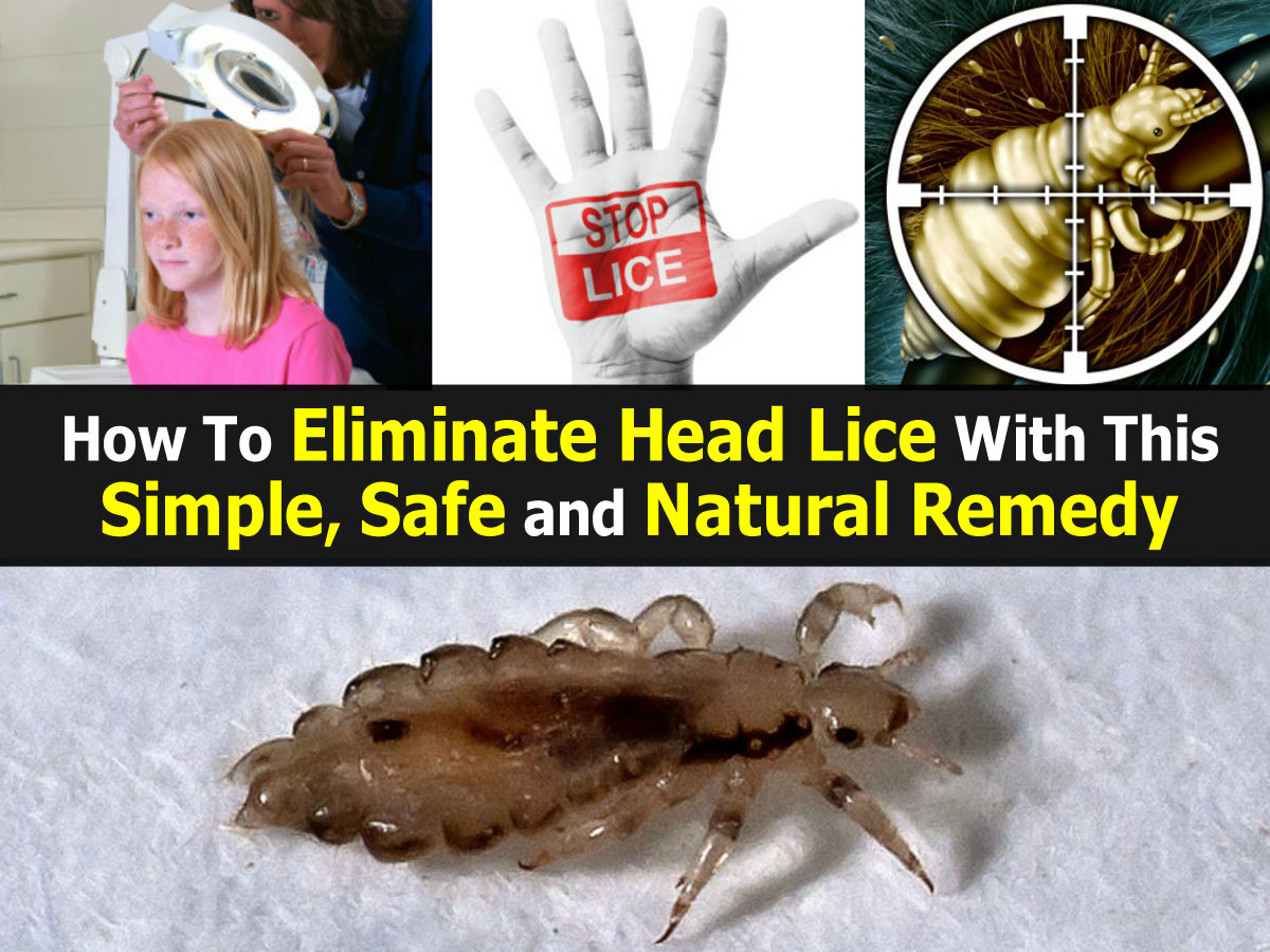 How To Eliminate Head Lice With This Simple, Safe and Natural Remedy